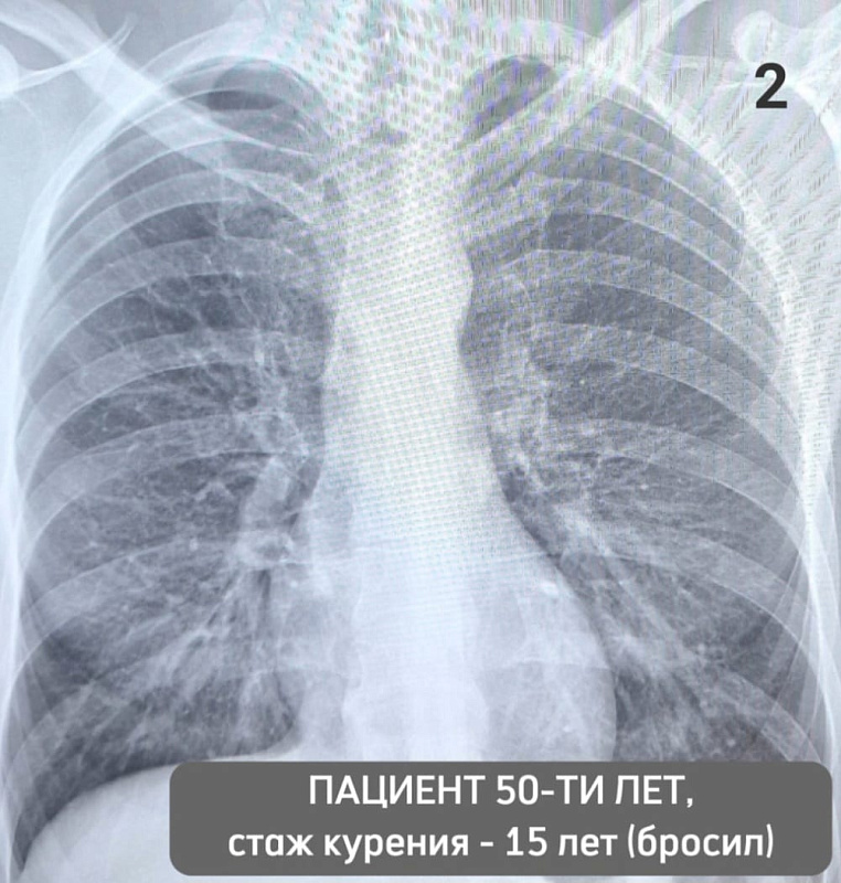 Сегодня Всемирный день без табака